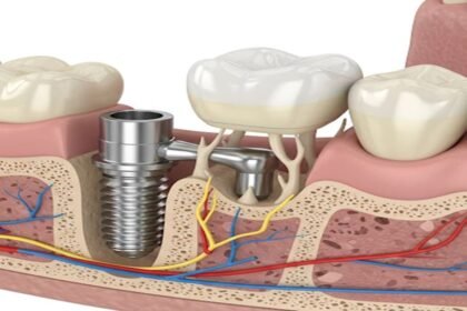 Dental Implants in Turkey