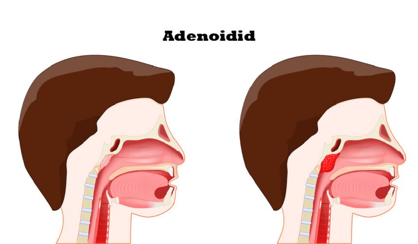 Adenoidid