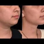 What Are the Most Effective Options for Double Chin Removal in Dubai?