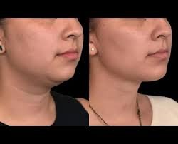 What Are the Most Effective Options for Double Chin Removal in Dubai?
