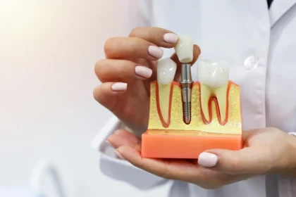 Dental Implants