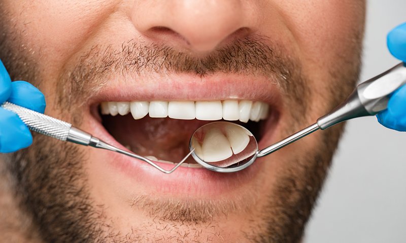 Dental Implants