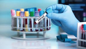 PSA Screening ICD-10: Key Codes and Best Practices for Prostate Cancer Detection
