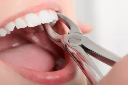 Wisdom Teeth Removal